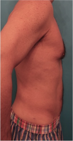 Male Liposuction Patient #2 After Photo # 12