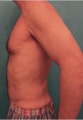 Male Liposuction Patient #2 After Photo Thumbnail # 8
