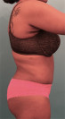 Abdominoplasty/ Tummy Tuck Patient #4 After Photo Thumbnail # 10