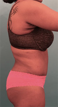 Abdominoplasty/ Tummy Tuck Patient #4 After Photo # 10