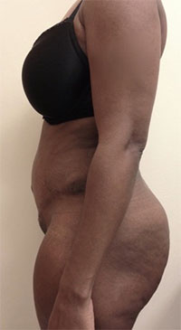 Abdominoplasty/ Tummy Tuck Patient #8 After Photo # 6