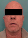 Male Laser Resurfacing Patient #1 Before Photo Thumbnail # 1