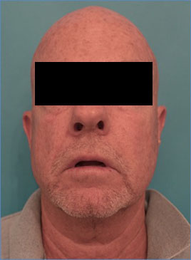 Male Laser Resurfacing Patient #1 Before Photo # 1