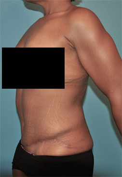 Abdominoplasty/ Tummy Tuck Patient #6 After Photo # 8
