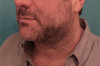 Male Kybella Patient #5 After Photo Thumbnail # 8
