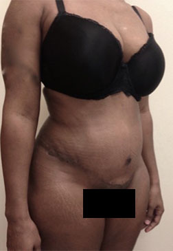 Abdominoplasty/ Tummy Tuck Patient #8 After Photo # 8