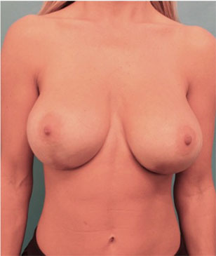 Breast Augmentation (Implants) Patient #8 After Photo # 2