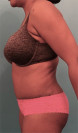 Abdominoplasty/ Tummy Tuck Patient #4 After Photo Thumbnail # 6