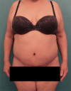 Abdominoplasty/ Tummy Tuck Patient #9 After Photo Thumbnail # 2
