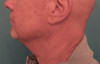 Male Kybella Patient #6 Before Photo Thumbnail # 1