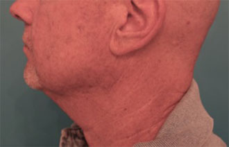 Male Kybella Patient #6 Before Photo # 1