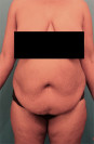 Abdominoplasty/ Tummy Tuck Patient #7 Before Photo Thumbnail # 1