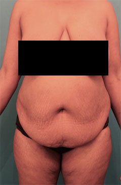 Abdominoplasty/ Tummy Tuck Patient #7 Before Photo # 1