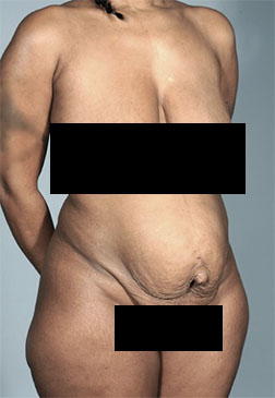 Abdominoplasty/ Tummy Tuck Patient #8 Before Photo # 7