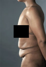 Abdominoplasty/ Tummy Tuck Patient #6 Before Photo Thumbnail # 9