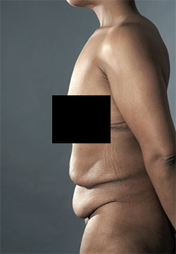 Abdominoplasty/ Tummy Tuck Patient #6 Before Photo # 9