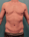 Male Abdominoplasty / Tummy Tuck Patient