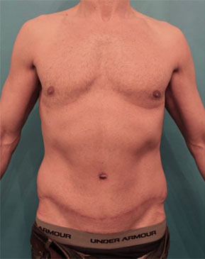 Male Abdominoplasty/Tummy Tuck Patient #1 After Photo # 2