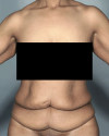 Abdominoplasty/ Tummy Tuck Patient #6 Before Photo Thumbnail # 1