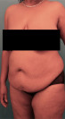 Abdominoplasty/ Tummy Tuck Patient #7 Before Photo Thumbnail # 3
