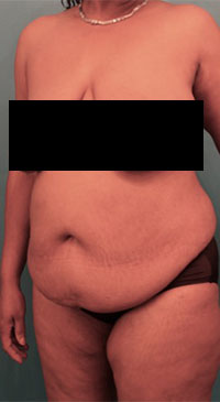 Abdominoplasty/ Tummy Tuck Patient #7 Before Photo # 3