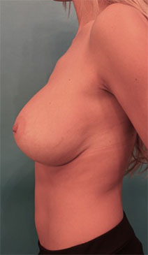 Breast Lift Patient #5 After Photo # 6