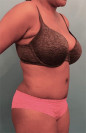 Abdominoplasty/ Tummy Tuck Patient #4 After Photo Thumbnail # 8