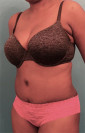Abdominoplasty/ Tummy Tuck Patient #4 After Photo Thumbnail # 4