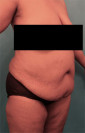 Abdominoplasty/ Tummy Tuck Patient #7 Before Photo Thumbnail # 7