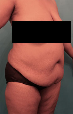 Abdominoplasty/ Tummy Tuck Patient #7 Before Photo # 7