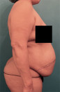 Abdominoplasty/ Tummy Tuck Patient #9 Before Photo Thumbnail # 9