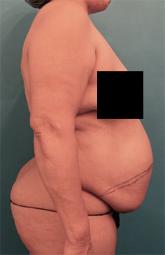 Abdominoplasty/ Tummy Tuck Patient #9 Before Photo # 9