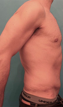 Male Abdominoplasty/Tummy Tuck Patient #1 After Photo # 6