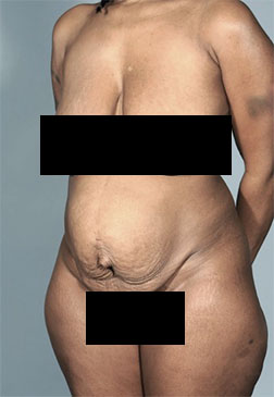 Abdominoplasty/ Tummy Tuck Patient #8 Before Photo # 3