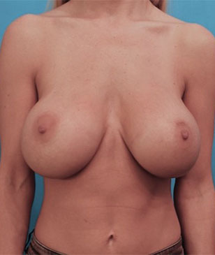 Breast Augmentation (Implants) Patient #8 Before Photo # 1