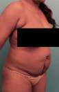 Abdominoplasty/ Tummy Tuck Patient #4 Before Photo Thumbnail # 7