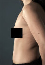 Liposuction Patient #6 Before Photo Thumbnail # 7