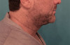 Male Kybella Patient #5 After Photo Thumbnail # 6