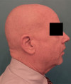 Male Laser Resurfacing Patient #1 After Photo Thumbnail # 10