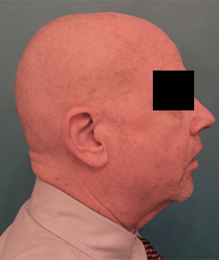 Male Laser Resurfacing Patient #1 After Photo # 10