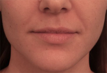 Dermal Fillers (Facial Contouring) Patient #1 Before Photo # 1