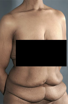 Abdominoplasty/ Tummy Tuck Patient #6 Before Photo # 3