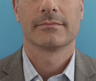 Male Kybella Patient #1 After Photo # 2