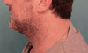 Male Kybella Patient #5 After Photo Thumbnail # 4