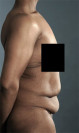 Abdominoplasty/ Tummy Tuck Patient #6 Before Photo Thumbnail # 5
