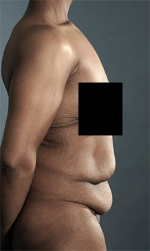 Abdominoplasty/ Tummy Tuck Patient #6 Before Photo # 5