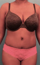 Abdominoplasty/ Tummy Tuck Patient #4 After Photo Thumbnail # 2
