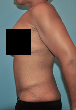 Abdominoplasty/ Tummy Tuck Patient #6 After Photo # 10