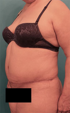 Abdominoplasty/ Tummy Tuck Patient #9 After Photo # 4
