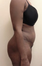 Abdominoplasty/ Tummy Tuck Patient #8 After Photo Thumbnail # 10